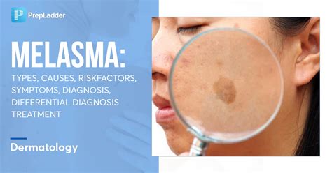 Melasma Types Causes Risk Factors Symptoms Diagnosis Differential
