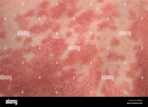 Psoriatic Plaques Hi Res Stock Photography And Images Alamy