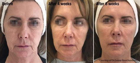 Profhilo Before And After Dundrum Cosmetic Clinic
