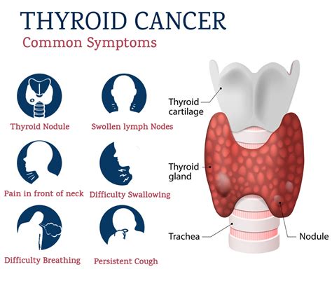 Causes And Types Of Thyroid Cancer Drvijay Anand Reddy