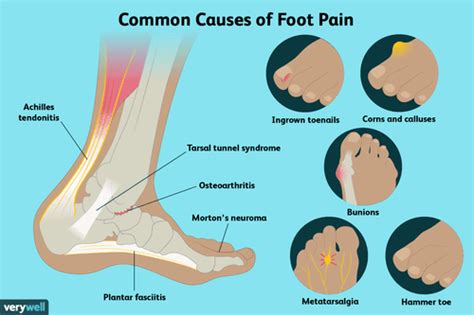 Foot Pain Causes Treatment And When To See A Doctor
