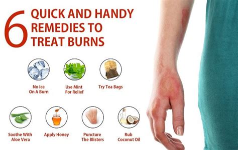 Home Remedies To Treat Burns Dafcuk Treat Burns Remedies Home