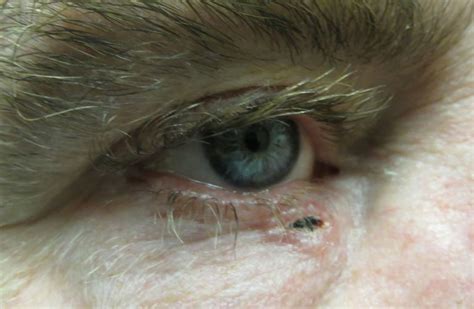 Moran Core Eyelid Masses