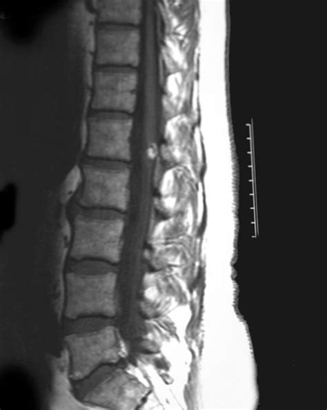 Conus Medullaris Lesion Causing Bilateral Lower Limb Myokymia Bmj