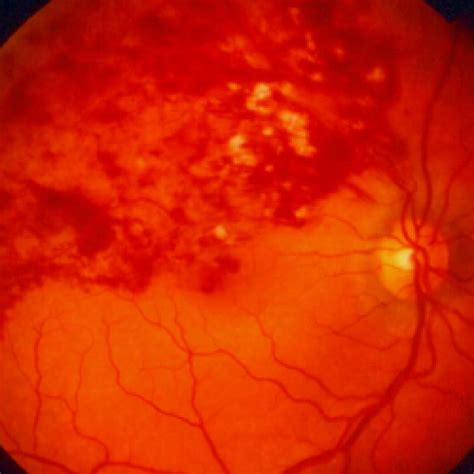 Branch Retinal Vein Occlusion Retina Associates Of St Louis