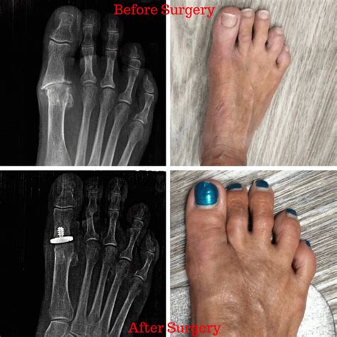 Arthritic Joint Reconstruction Surgery Foot And Ankle Wellness Centre