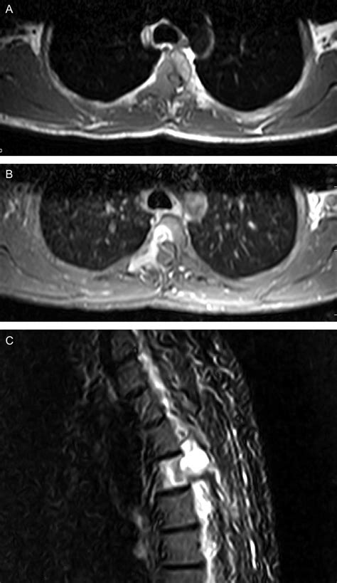 MRI With And Without Contrast Of Thoracic Spine Axial A B And Download Scientific Diagram