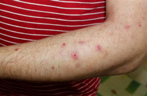 Nemolizumab Alleviates Skin Symptoms In Prurigo Nodularis Latest News
