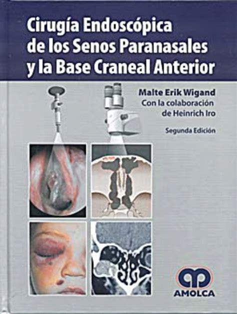 Cirugía Endoscópica De Los Senos Paranasales Y La Base Craneal Anterior 0