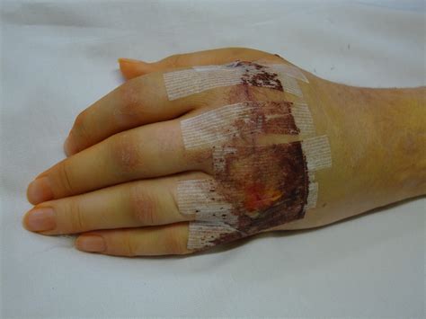 Gwens Feet And Hand Follow Up And Splints