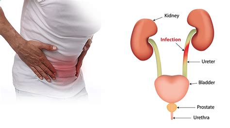 Urinary Tract Infections In Men Cinebuzz Times