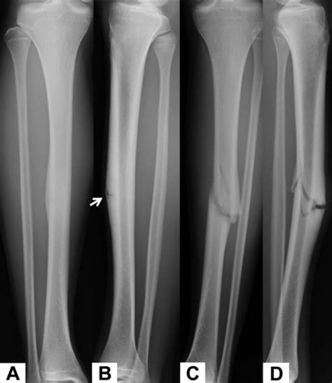 Injury Radiographs A Anteroposterior And B Lateral Open I