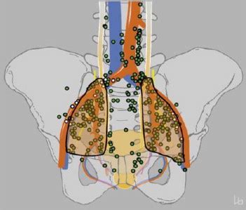 Standardized And Simplified Extended Pelvic Lymph Node Dissection During Robot Assisted Radical