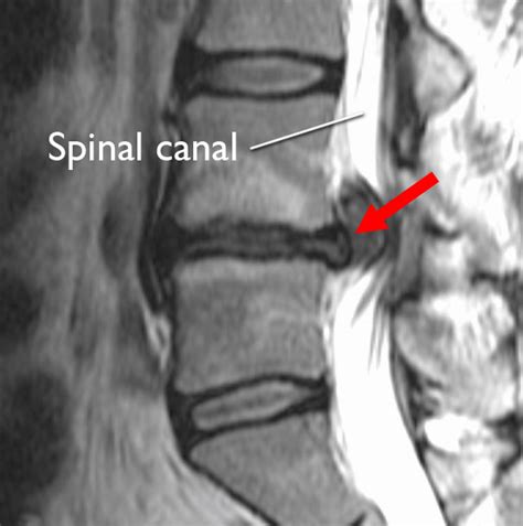 How To Read The Mri For A Herniated Disc And 5 Treatment Options