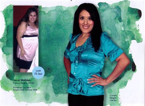 Weight Loss Surgery Before After Photos Soma Bariatrics Los Angeles