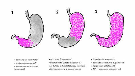 Как лечить атрофический очаговый гастрит: Лечение хронического Картинка - Как лечить атрофический очаговый гастрит: Лечение хронического