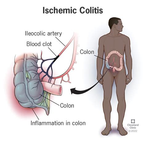 Understanding Ischemic Colitis Causes Symptoms Diagnosis And Treatment