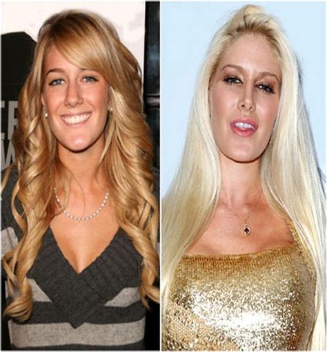 Heidi Montag Before And After