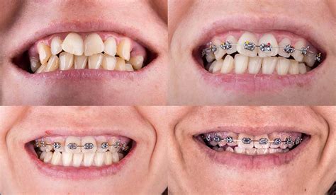 Everything You Need To Know About Braces Istanbul Dental Care