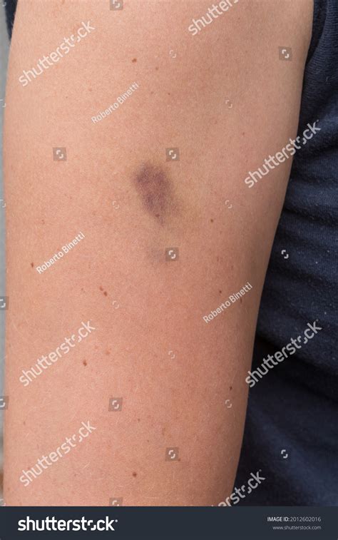 Hematoma Bruise On Woman Arm Pain Stock Photo 2012602016 Shutterstock