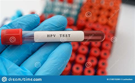 Hpv Test Result With Blood Sample In Test Tube On Doctor Hand In