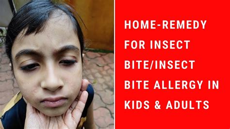 Home Remedy For Insect Bitesinsect Bite Allergies In Kids And Adults