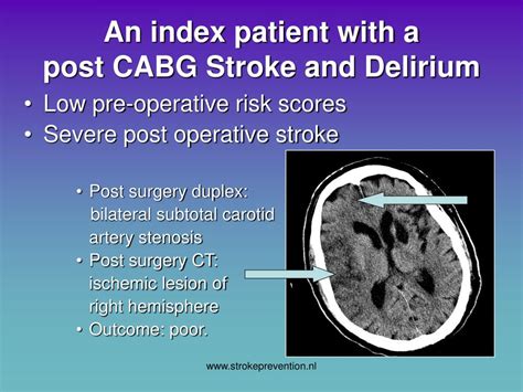 Ppt Stroke And Delirium Prevention In Cabg Surgery ‘the Haga Brain