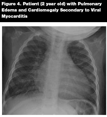 Most of the time, it is caused by an infection that reaches the heart. Presentation, Assessment, and Management of Acute ...