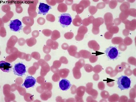 Histopathology Images Of Hairy Cell Leukemia Classic By