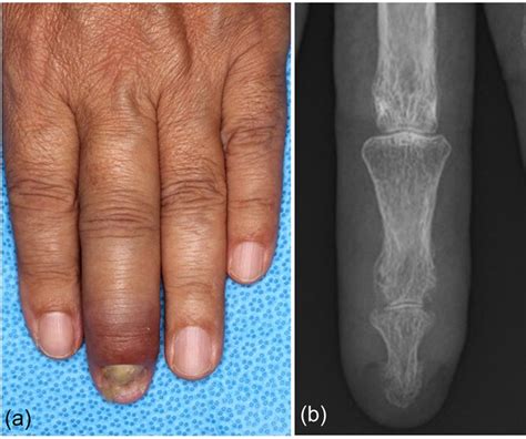 Acrodermatitis Continua Of Hallopeau With Psoriatic Arthritis Treated