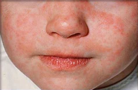 First Signs And Treatment Of Measles