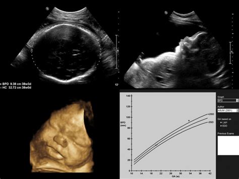 Fetal Growth Ultrasound