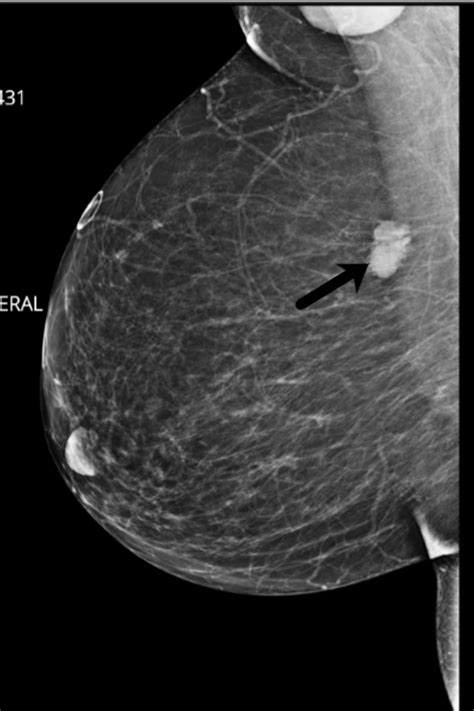 Cureus Adenoid Cystic Carcinoma Of The Breast A Case Report