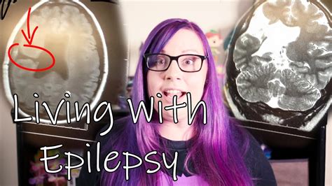 Living With Epilepsy Youtube