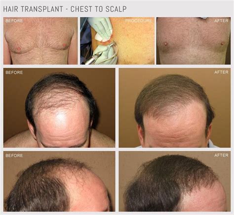 What Are The Types Of Procedures For Hair Transplants 1 Follicular