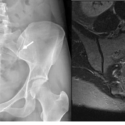 Bilateral Sacroiliitis Sii Joint Space Narrowing And Sclerosis On