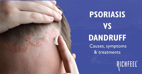 Psoriasis Vs Dandruff Causes Symptoms And Treatments Richfeel