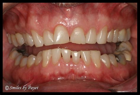 Teeth Grinding Bruxism Dental Nightguard Dentist Charlotte Nc