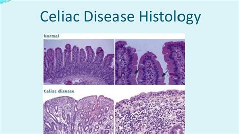 Celiac Disease A Brief Overview Youtube