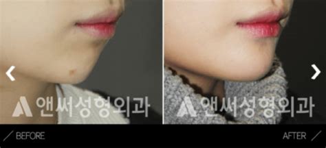 Chin Implant Guide Chin Augmentation Cost In Korea Recovery Before