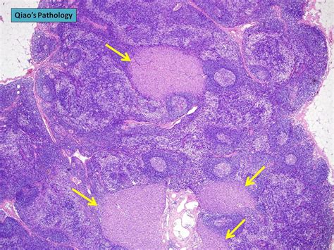 Qiaos Pathology Positive Axillary Lymph Node With Metastatic Lobular