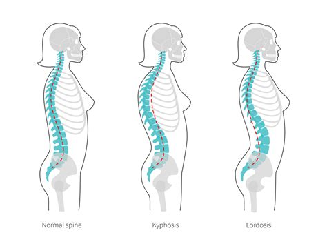 How Can Chiropractic Treat Cervical Lordosis