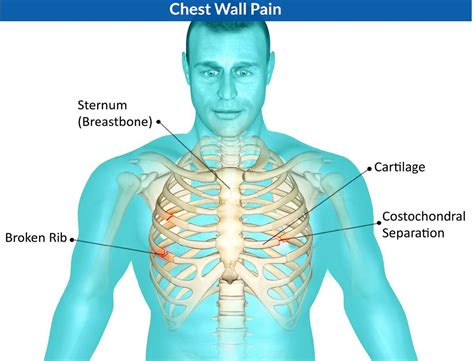 Information Of Chest Pain Costochondritis Symptoms