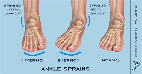 Managing Acute And Recurrent Ankle Sprains Mass4d Foot Orthotics