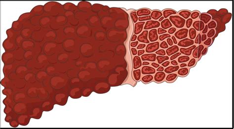 Management Of Pancytopenia In Alcohol Induced Liver Cirrhosis In Young