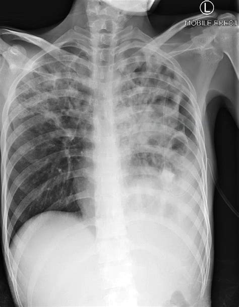 Consolidation Chest X Ray