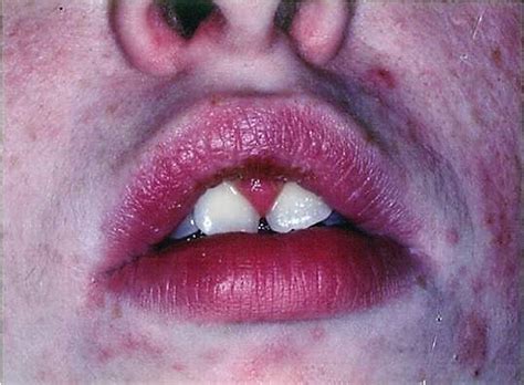 Purple Spots On Lips Nhs