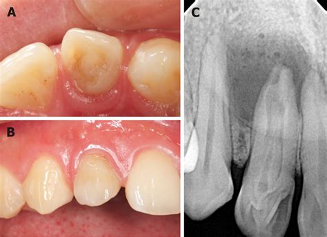 Conventional Treatment Of Dens Invaginatus In Maxillary Lateral Incisor