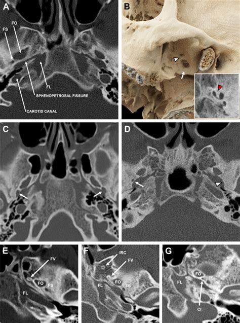 Anatomy Of The Calvaria And Skull Base Neuroimaging Clinics