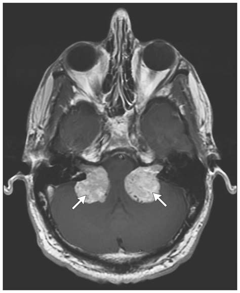 Bilateral Vestibular Schwannomas In Neurofibromatosis Type 2 Nejm